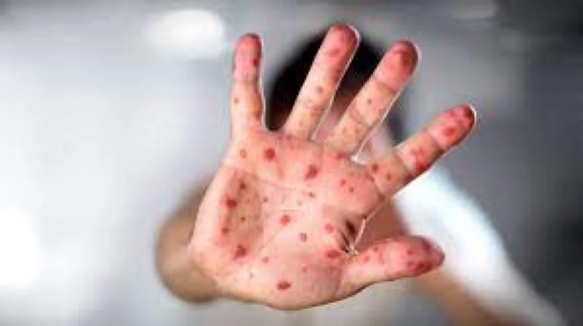 Министрлік: Қызылша жұқтырған балалардың 83 пайызы екпе алмаған