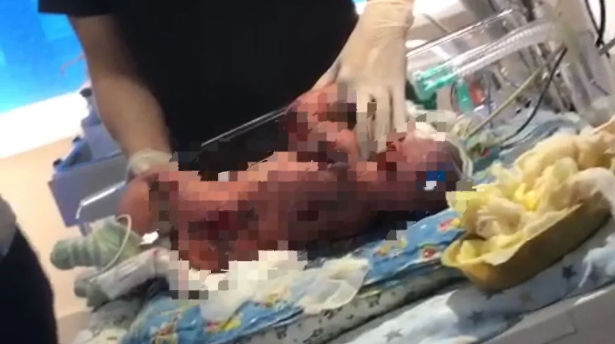 Семейде жаңа туған нәресте перзентханада оңбай күйіп қалды