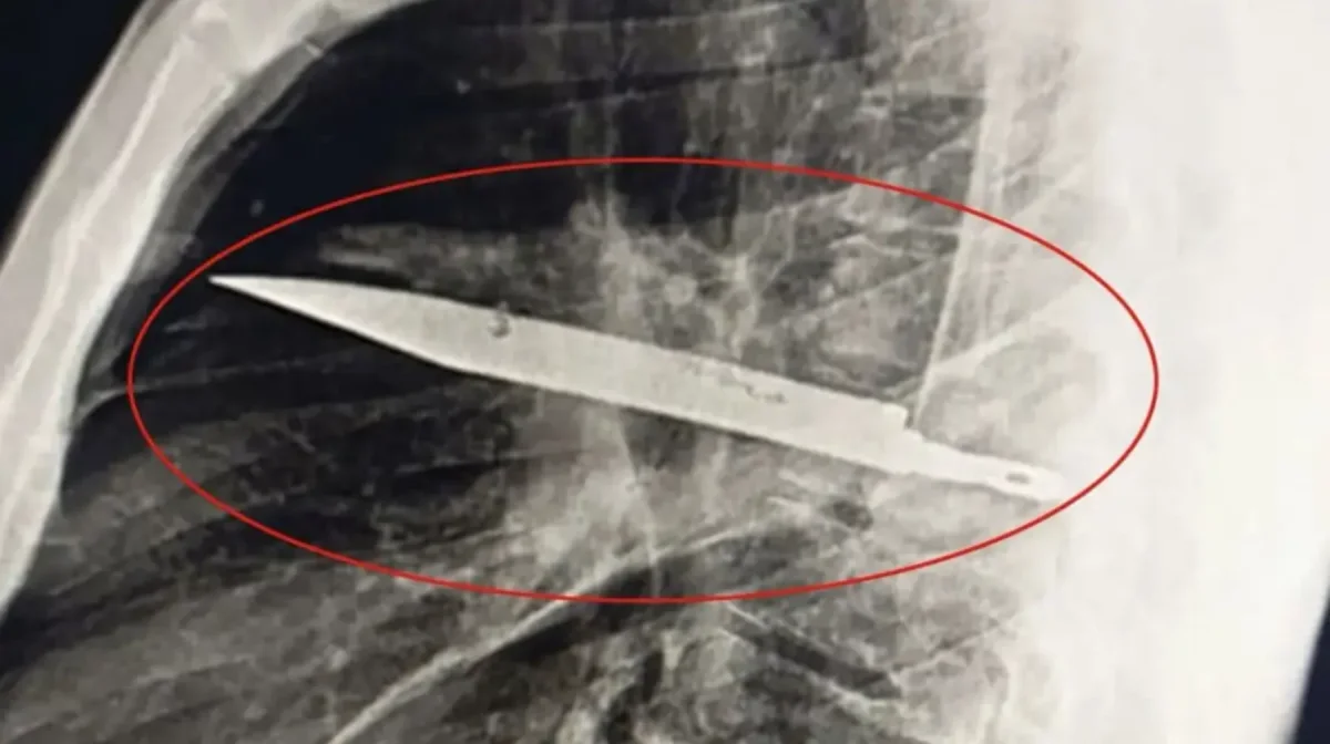 Ер адам кеуде тұсында пышақ барын 8 жылдан кейін бір-ақ білген