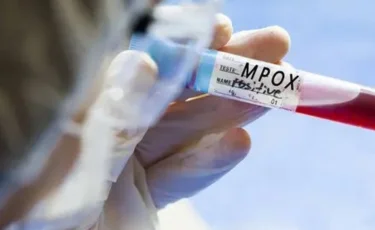 АҚШ-та маймыл шешегін адамға жұқтырудың алғашқы жағдайы анықталды