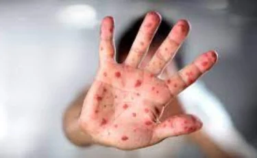 Министрлік: Қызылша жұқтырған балалардың 83 пайызы екпе алмаған