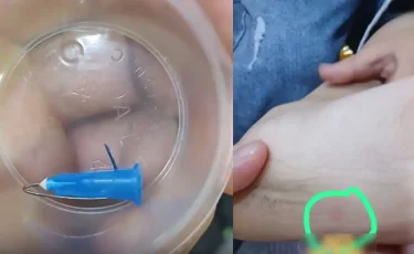 Астанадағы кафеде баланың аяғына медициналық шприц кіріп кеткен