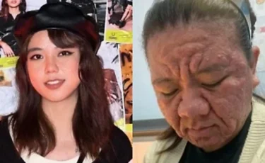 «Бетім күйіп тұрғандай»: 28 жастағы әйел жүктілік кезінде ондаған жылға қартайып кетті