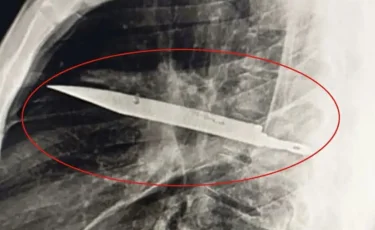 Ер адам кеуде тұсында пышақ барын 8 жылдан кейін бір-ақ білген